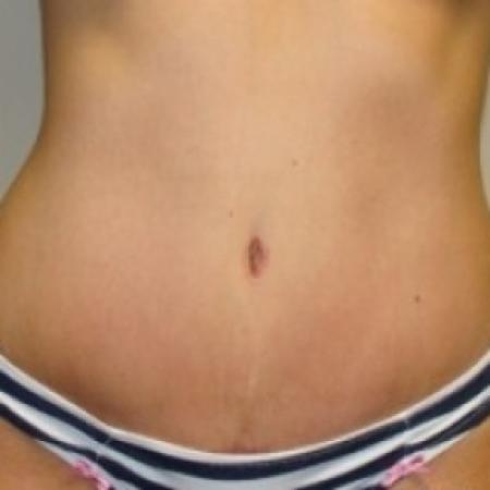 After image 1 Case #79496 - Tummy Tuck
