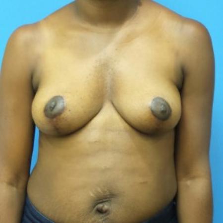 After image 1 Case #86946 - 39 year old  - Bilateral Breast Lift  - 3 months post-op