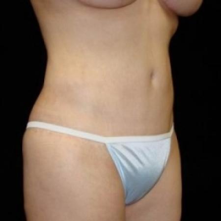 After image 5 Case #80226 - Circumfrential Abdominoplasty with Liposuction of Abdomen, Waist, and Flanks
