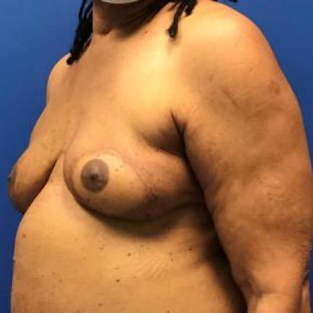 After image 2 Case #88426 - Breast Reconstruction on a 63 year old female
