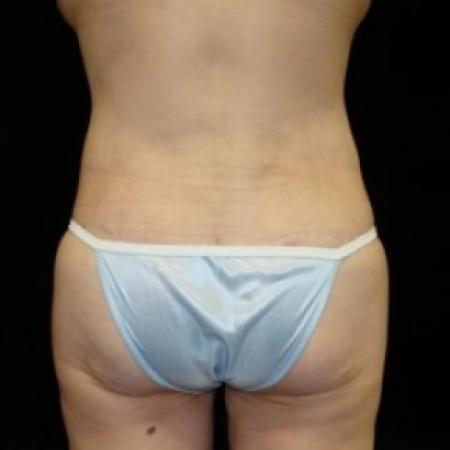 After image 6 Case #80226 - Circumfrential Abdominoplasty with Liposuction of Abdomen, Waist, and Flanks