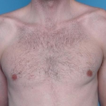 After image 1 Case #79266 - Male Breast Reduction