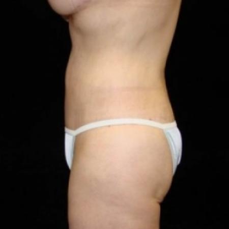 After image 3 Case #80226 - Circumfrential Abdominoplasty with Liposuction of Abdomen, Waist, and Flanks