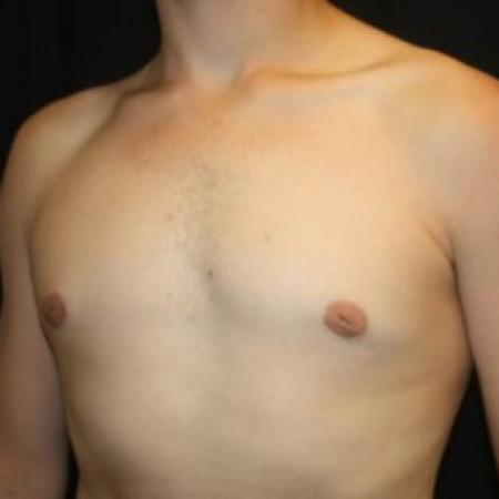After image 2 Case #84536 - Gynecomastia - 17 year old male