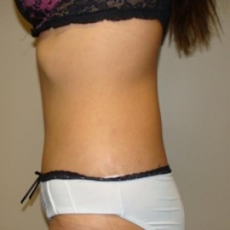 After image 5 Case #80116 - Abdominoplasty