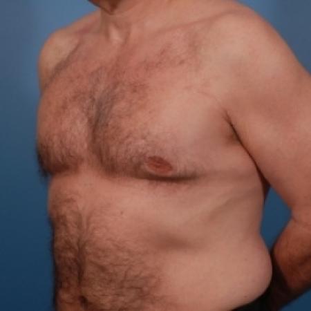 After image 2 Case #79066 - Gynecomastia Treatment