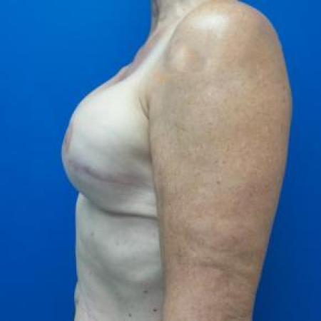 After image 2 Case #88151 - Breast Reconstruction on a 68 year old female