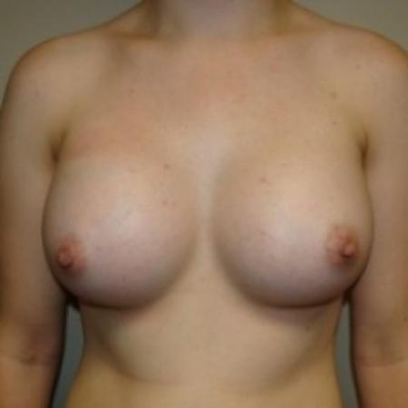 After image 1 Case #79721 - Breast Augmentation