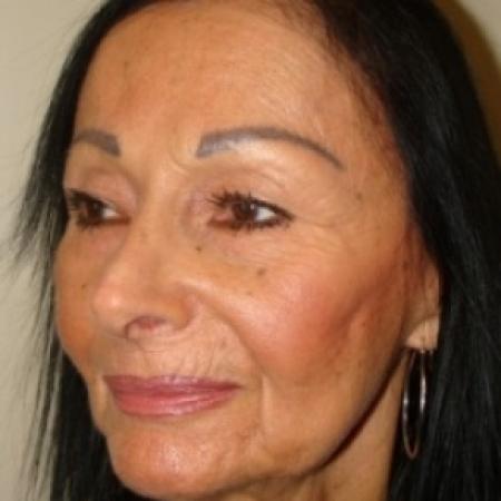 After image 2 Case #79546 - Rhinoplasty