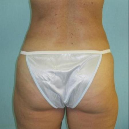 After image 2 Case #82731 - Liposculpture - hips and thighs