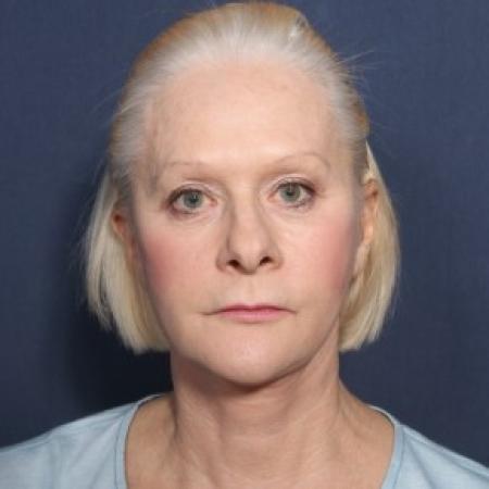 After image 1 Case #84356 - 67 Years Old Female