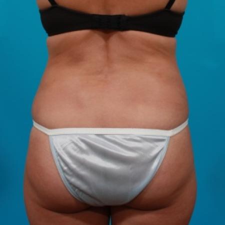 After image 5 Case #80771 - Tummy Tuck & Flank Liposuction