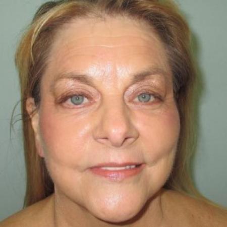 After Case #82671 - Chemical peel - mouth area