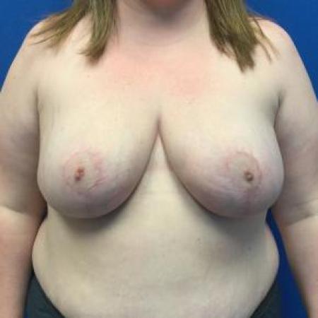 After image 1 Case #88376 - Breast Reduction on a 28 year old female 