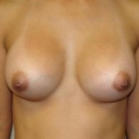 After image 1 Case #79391 - Breast Augmentation