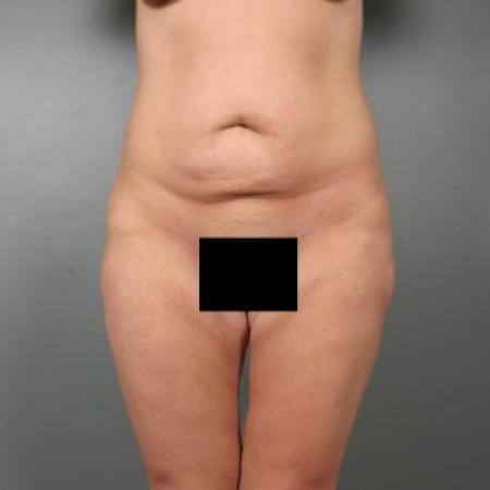 After image 1 Case #83591 - Liposuction Abdomen and Thighs