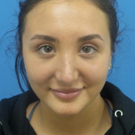 After image 1 Case #88381 - 21 year-old  -  Rhinoplasty  -  4 months post-op