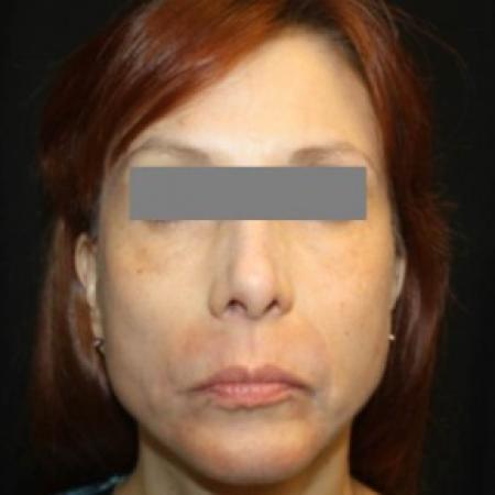 After image 1 Case #84386 - Facelift/Facial Rejuvenation - 54 year old female