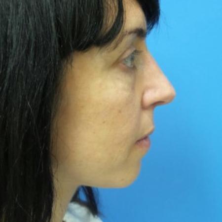 After image 3 Case #86856 - 40 year old woman treated with Nose Surgery/Septoplasty/Turbinectomy