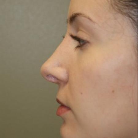 After image 2 Case #81871 - Open Septorhinoplasty