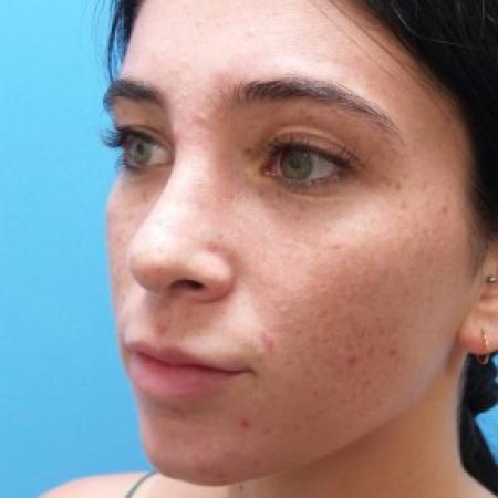 After image 2 Case #87441 - 21 year old  -  Rhinoplasty  -  6 months post-op
