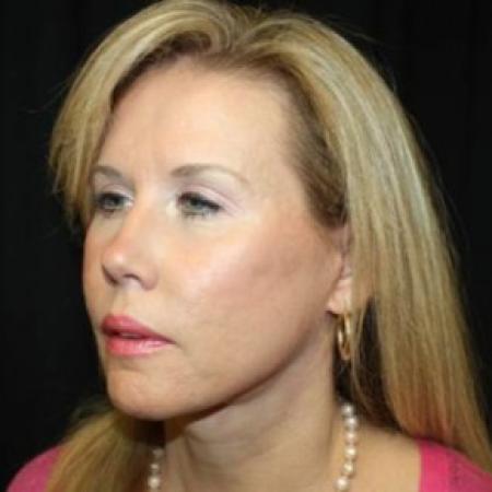 After image 2 Case #85286 - Facelift and Neck Lift - 54 year old female