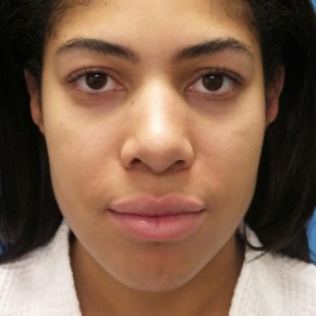 After image 1 Case #86446 - Rhinoplasty - 3 months post-op