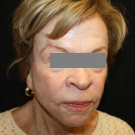 After image 2 Case #85601 - Phenol and Croton Oil Peel - 76 year old female