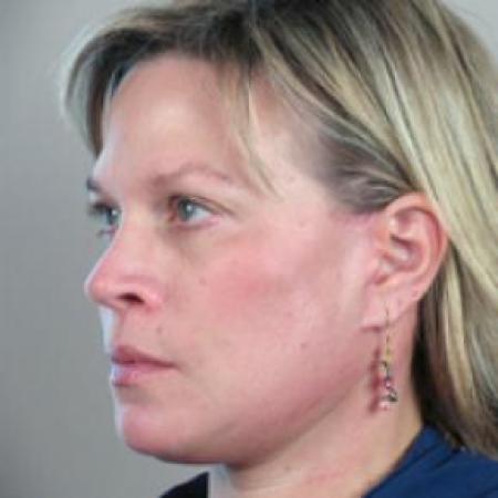 After image 1 Case #80656 - Facelift New Jersey