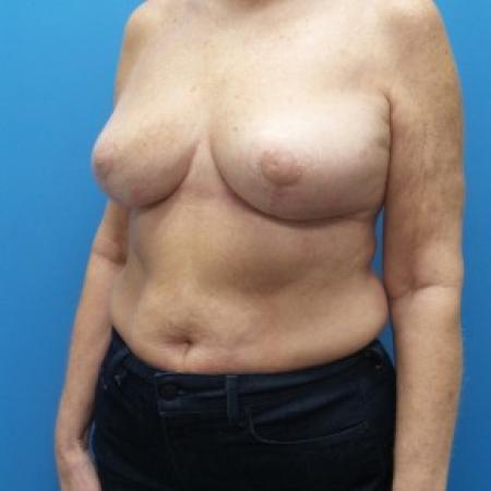 After image 2 Case #86531 - Bilateral Breast Reduction