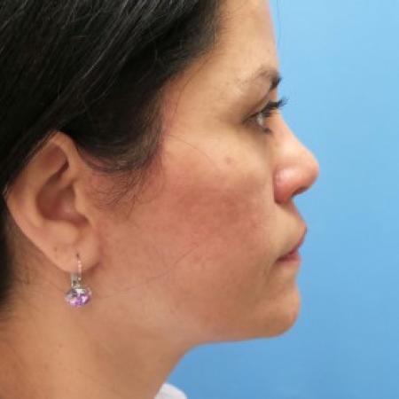 After image 3 Case #87341 - 54-year old - Upper & Lower Blepharoplasty/Facelift/Fat Grafting  to  Upper Cheeks & Lower Lids/Skin Resurfacing to both cheeks   3 months post-op