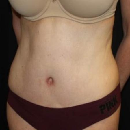 After image 2 Case #84716 - Abdominoplasty - 49 year old female.