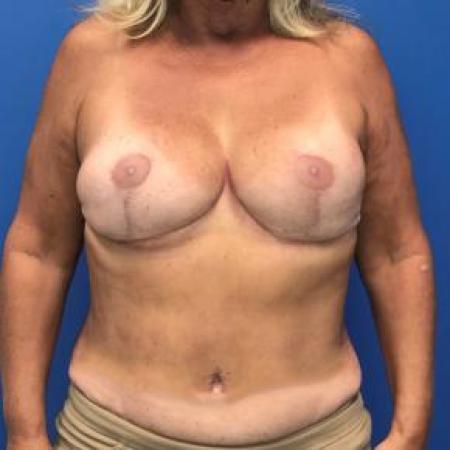 After image 1 Case #88421 - Breast reconstruction on a 59 year old female