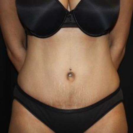 After image 1 Case #85591 - Abdominoplasty - 44 year old female