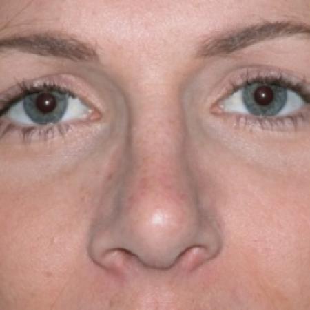 After image 1 Case #79251 - Rhinoplasty