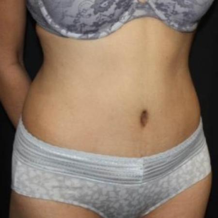 After image 2 Case #85021 - Abdominoplasty - 39 year old female