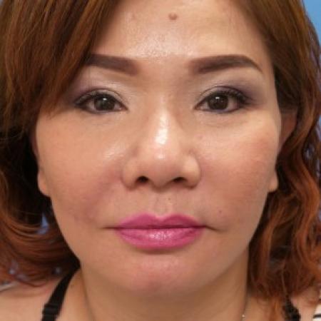After image 1 Case #86586 - Facelift