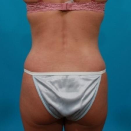 After image 5 Case #78946 - Tummy Tuck & Flank Lipo