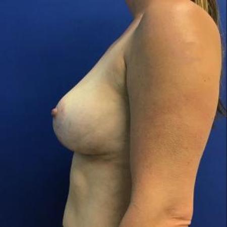 After image 3 Case #88116 - Removal of Implants and Mastopexy 
