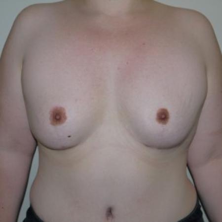 After image 1 Case #82331 - Severe breast asymmetry