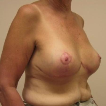 After image 2 Case #81106 - Breast Reduction