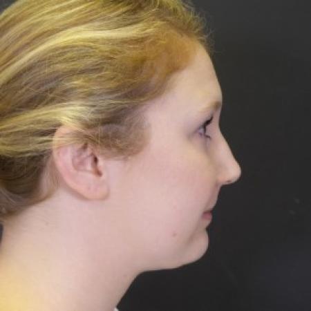 After image 2 Case #84146 - Chin Liposuction