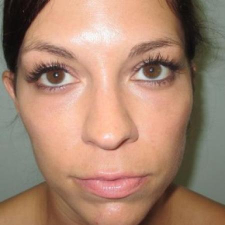 After image 1 Case #82706 - Fat Transfer to lower lids
