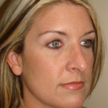 After image 2 Case #79536 - Rhinoplasty