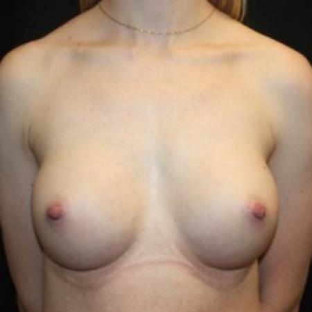 After image 1 Case #84921 - Breast Augmentation - 28 year old female