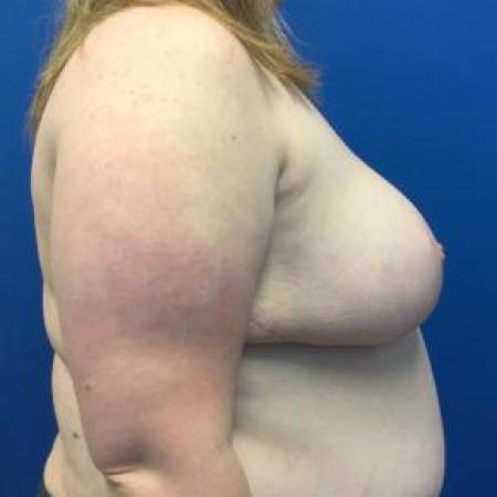 After image 2 Case #88376 - Breast Reduction on a 28 year old female 