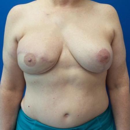 After image 1 Case #87631 - DIEP Flap Breast Reconstrution