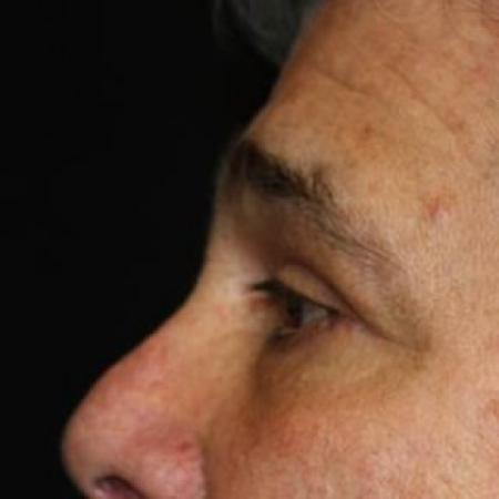 After image 3 Case #83461 - Blepharoplasty - 61 year old male.