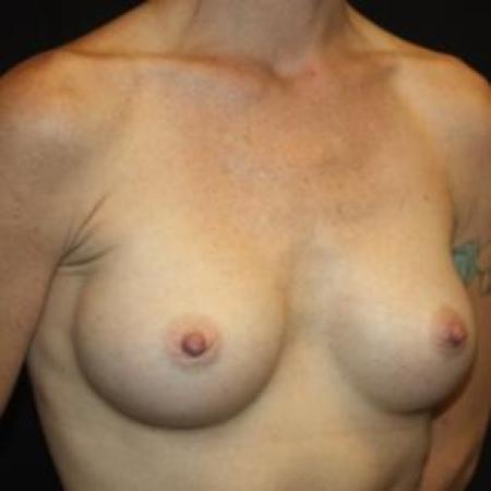 After image 2 Case #86056 - Breast Augmentation - 40 year old female