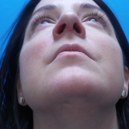After image 4 Case #88206 - 40 year old  -  Rhinoplasty & Septoplasty  -  1 month post-op